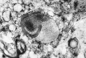 myelinoid inclusion in an unclassified tumor - peroxisome? myelinoid inclusion in an unclassified tumor - peroxisome?